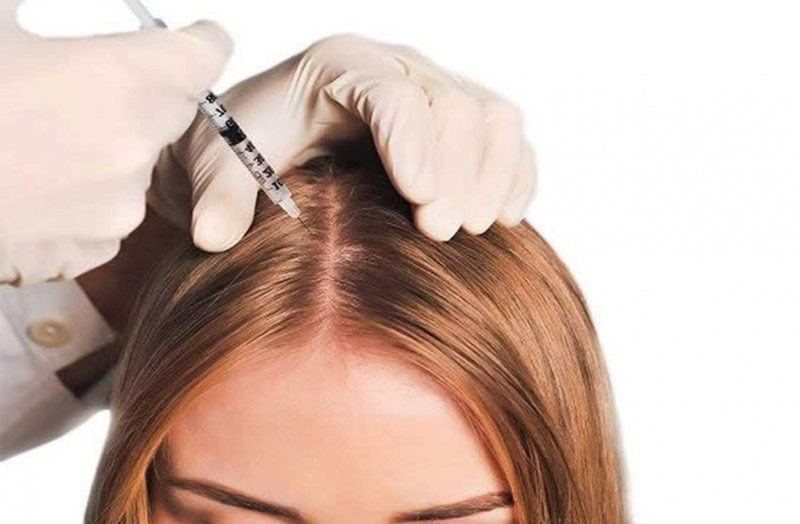 مزوژل مو با استفاده از تزریق مزوژل از طریق سرنگ به درون پوست سر انجام می‌شود