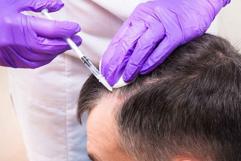 مزوژل مو روشی نوین برای درمان ریزش مو است